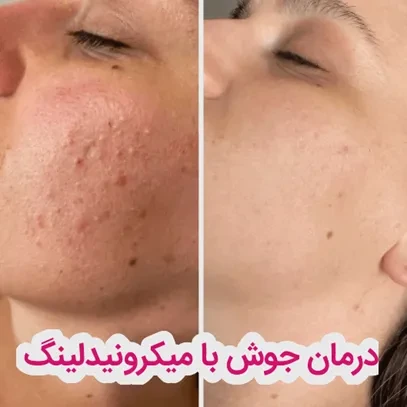چند جلسه میکرونیدلینگ برای درمان جای جوش لازم است؟
